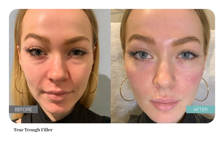Before and after treatment result — Dr. Lanna, LC Medical Aesthetics NYC
